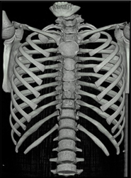 Pectus Deformity - CTisus CT Scan