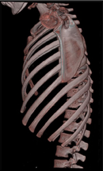 Pectus Deformity - CTisus CT Scan