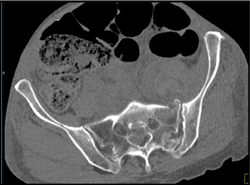 Sacral Fracture (s1- Left) - CTisus CT Scan