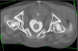 Sacral Symphysis Fractures - CTisus CT Scan