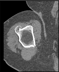 Exostosis - CTisus CT Scan