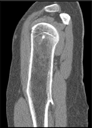 Exostosis - CTisus CT Scan