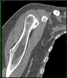 Exostosis - CTisus CT Scan