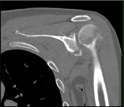 Scapular Fracture - CTisus CT Scan