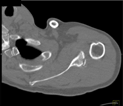 Scapular Fracture - CTisus CT Scan