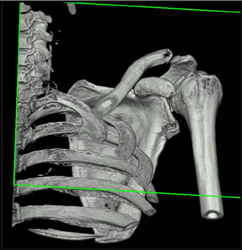 Scapular Fracture - CTisus CT Scan