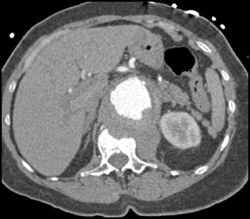 Aortic Aneurysm Erodes Spine - CTisus CT Scan