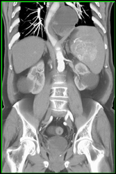 Islet Cell Tumor- See Next Case - CTisus CT Scan