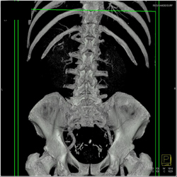 Islet Cell Cancer Metastatic to Bone- Transverse Process - CTisus CT Scan