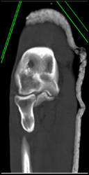 Trauma to Elbow - CTisus CT Scan