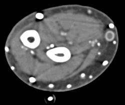 Clotted Dialysis Shunt With Nice 64 Slice CT Angio - CTisus CT Scan