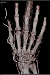 Clotted Dialysis Shunt With Nice 64 Slice CT Angio- Also Cellulitis of 3rd Digit - CTisus CT Scan