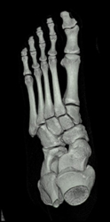 Normal Foot - CTisus CT Scan