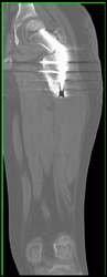 Nonunion - CTisus CT Scan