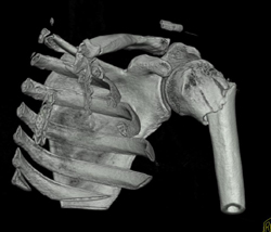 Humerus Fracture - CTisus CT Scan