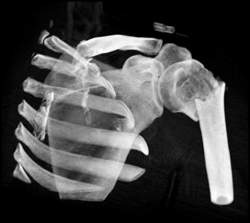 Humerus Fracture - CTisus CT Scan