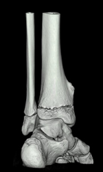 Exostosis - CTisus CT Scan