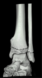 Exostosis - CTisus CT Scan