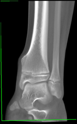 Exostosis - CTisus CT Scan