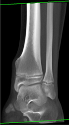 Exostosis - CTisus CT Scan