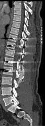 Post Spinal Fracture Repair - CTisus CT Scan