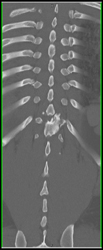 Fracture and Rotation - CTisus CT Scan