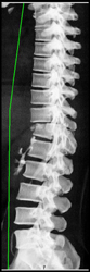 Post Repair of Fracture - CTisus CT Scan