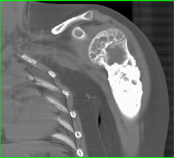 Bone Cyst With Prior Packing - CTisus CT Scan