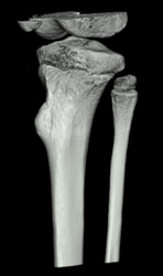 Exostosis - CTisus CT Scan