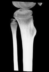 Exostosis - CTisus CT Scan