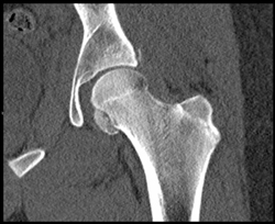 Humerus Fracture S/P Dislocation as Well as Acetabular Fracture - CTisus CT Scan