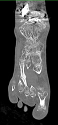 Healing Fracture of Metatarsal - CTisus CT Scan