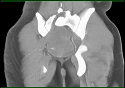 Ependymoma of Cord - CTisus CT Scan