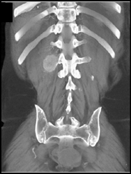 Metsastasic Islet Cell Tumor to Bone - CTisus CT Scan