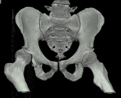 Hip Dislocation With Posterior Lip Fracture - CTisus CT Scan