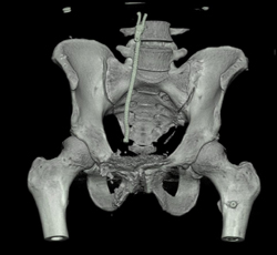 Repair of Diastasis of Symphyisis S/P Trauma - CTisus CT Scan