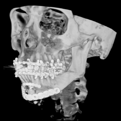 Post Repair of Mandibular Fracture - CTisus CT Scan