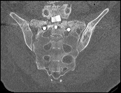 Post Repair of Sacral Fracture - CTisus CT Scan