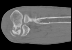 Avascular Necrosis (AVN) of Humerus - CTisus CT Scan