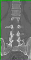 Compression Fracture of L1 - CTisus CT Scan