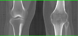 Fused Knee Joint - CTisus CT Scan