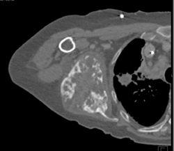 Chondrosarcoma - CTisus CT Scan