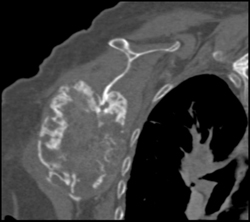 Chondrosarcoma - CTisus CT Scan