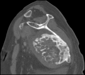 Chondrosarcoma - CTisus CT Scan