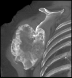 Chondrosarcoma - CTisus CT Scan