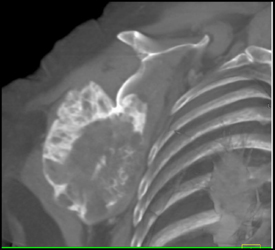 Chondrosarcoma - CTisus CT Scan