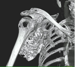 Chondrosarcoma - CTisus CT Scan