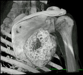 Chondrosarcoma - CTisus CT Scan