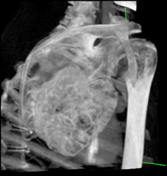 Chondrosarcoma - CTisus CT Scan