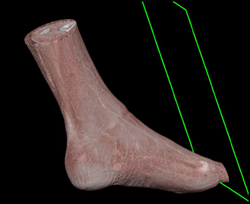 Cellulitis - CTisus CT Scan